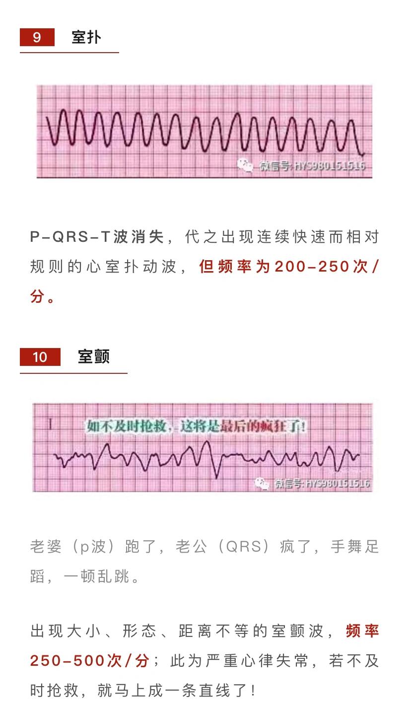 室扑与室颤的区别图解图片