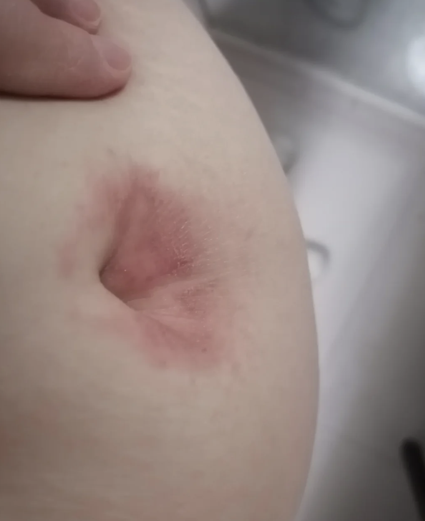 大人肚脐眼发炎流脓怎么回事怎么办?