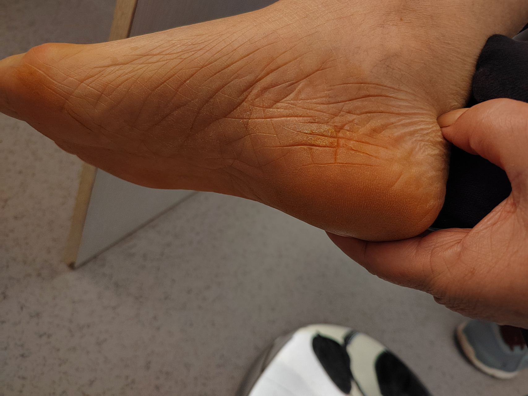 角化型湿疹使用生物制剂治疗后效果不错!治疗后图片.