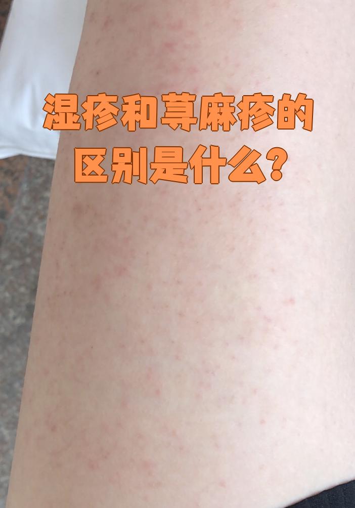 湿疹和荨麻疹是两种不同的皮肤病,主要区别在发病原因和症状表现. 