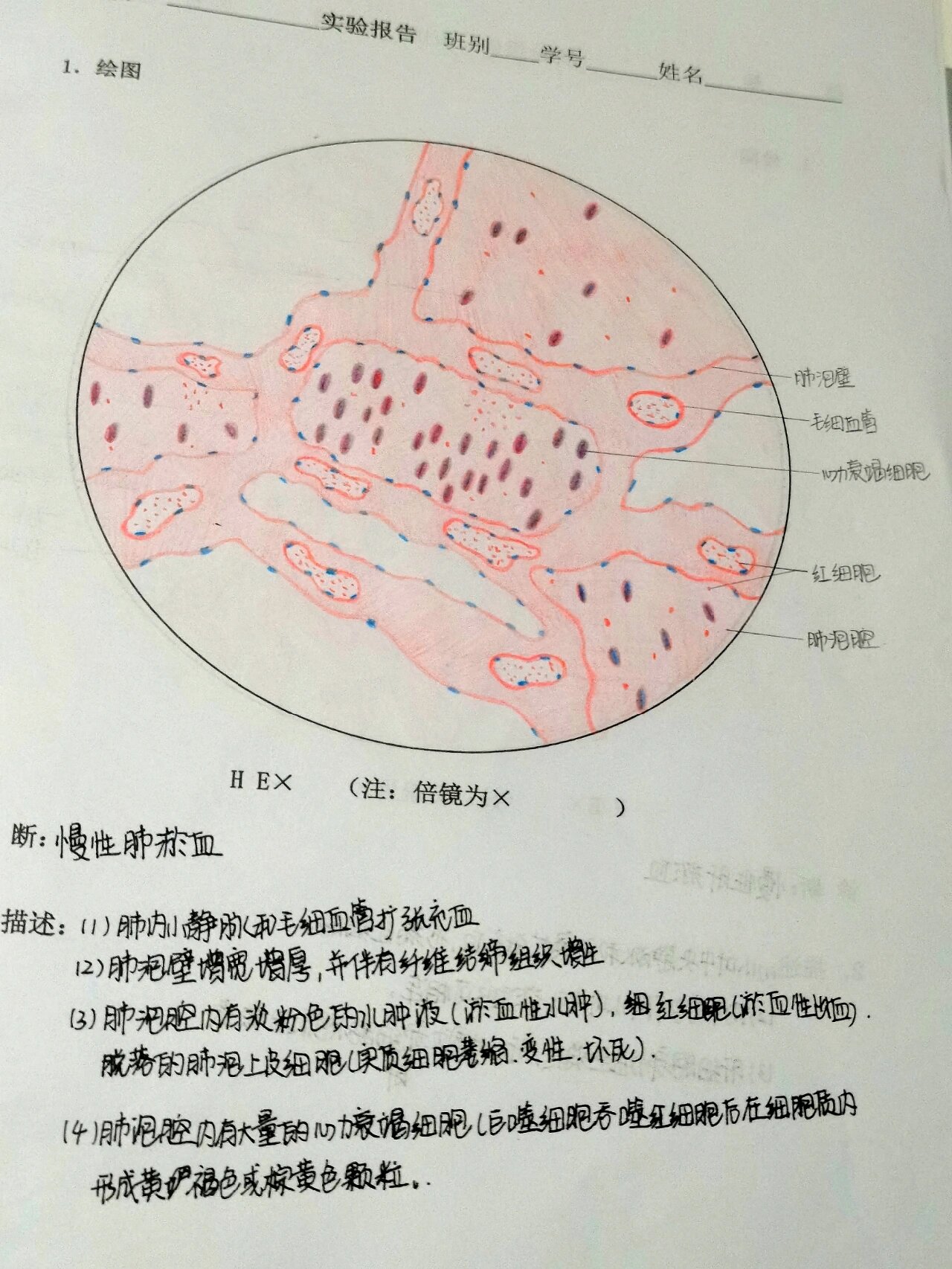 肺淤血病理作业图图片