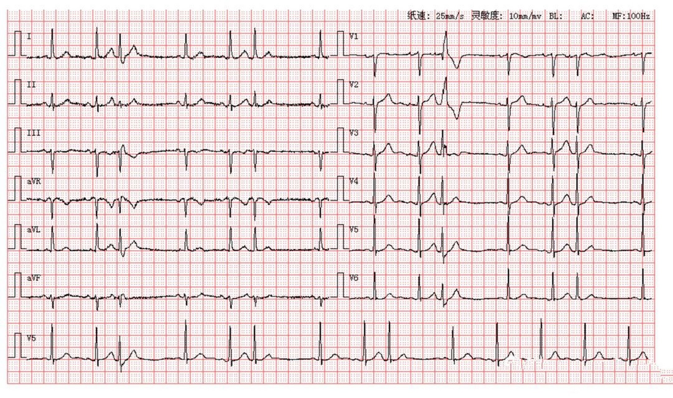 房性早搏伴室内差异性传导 房性早搏伴室内差异性传导 【 解析过程 】