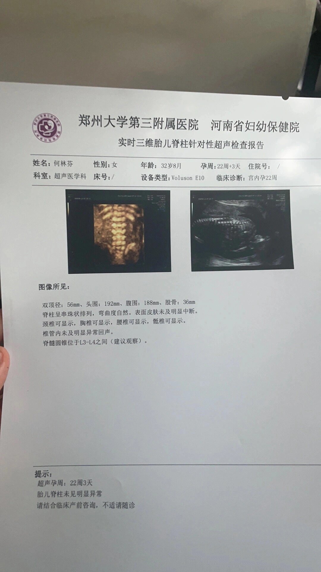 脊髓圆锥低位不要担心,相信宝宝 从22周的l4,到34周的l2-l3,宝宝可以