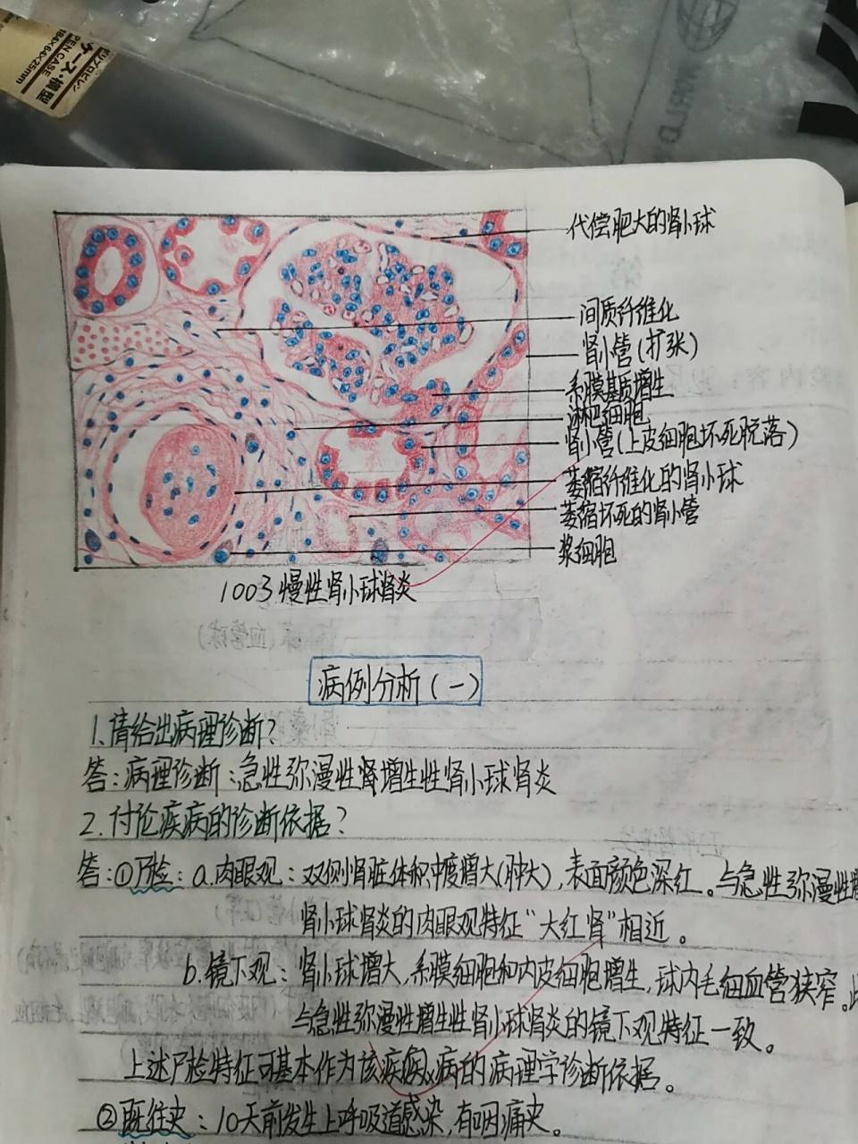 病理红蓝铅笔手绘图——泌尿系统疾病 99正常肾单位 99急性弥漫性