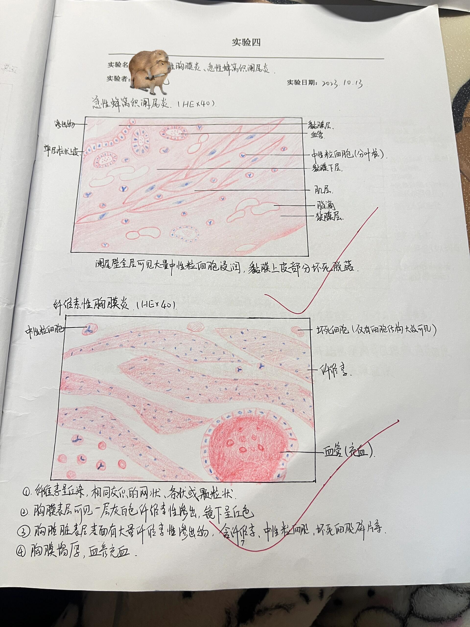 纤维素性胸膜炎,急性蜂窝织炎红蓝铅笔图 纤维素性胸膜炎 急性蜂窝织