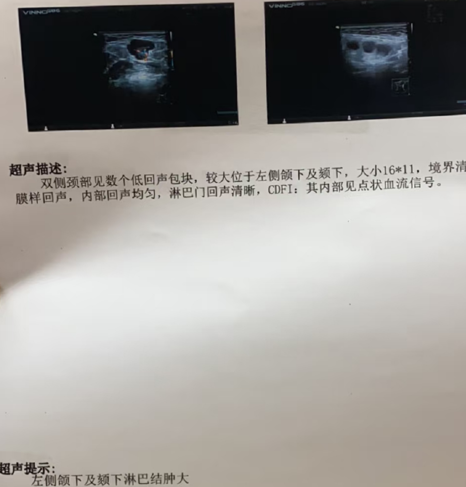 皮脂腺囊肿:这是因为皮脂腺的开口被堵住了,里面的油脂排不出来,慢慢