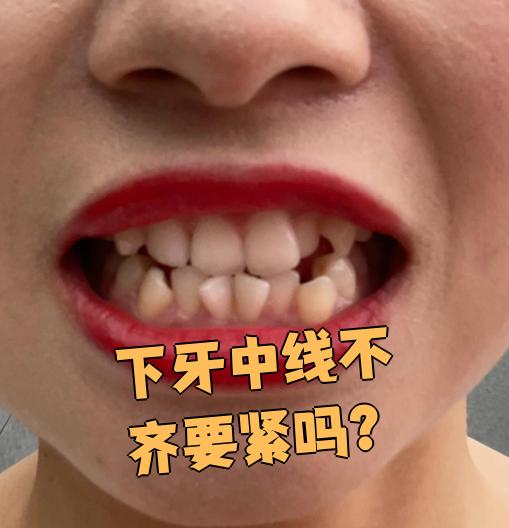 下牙中线不齐要看具体情况