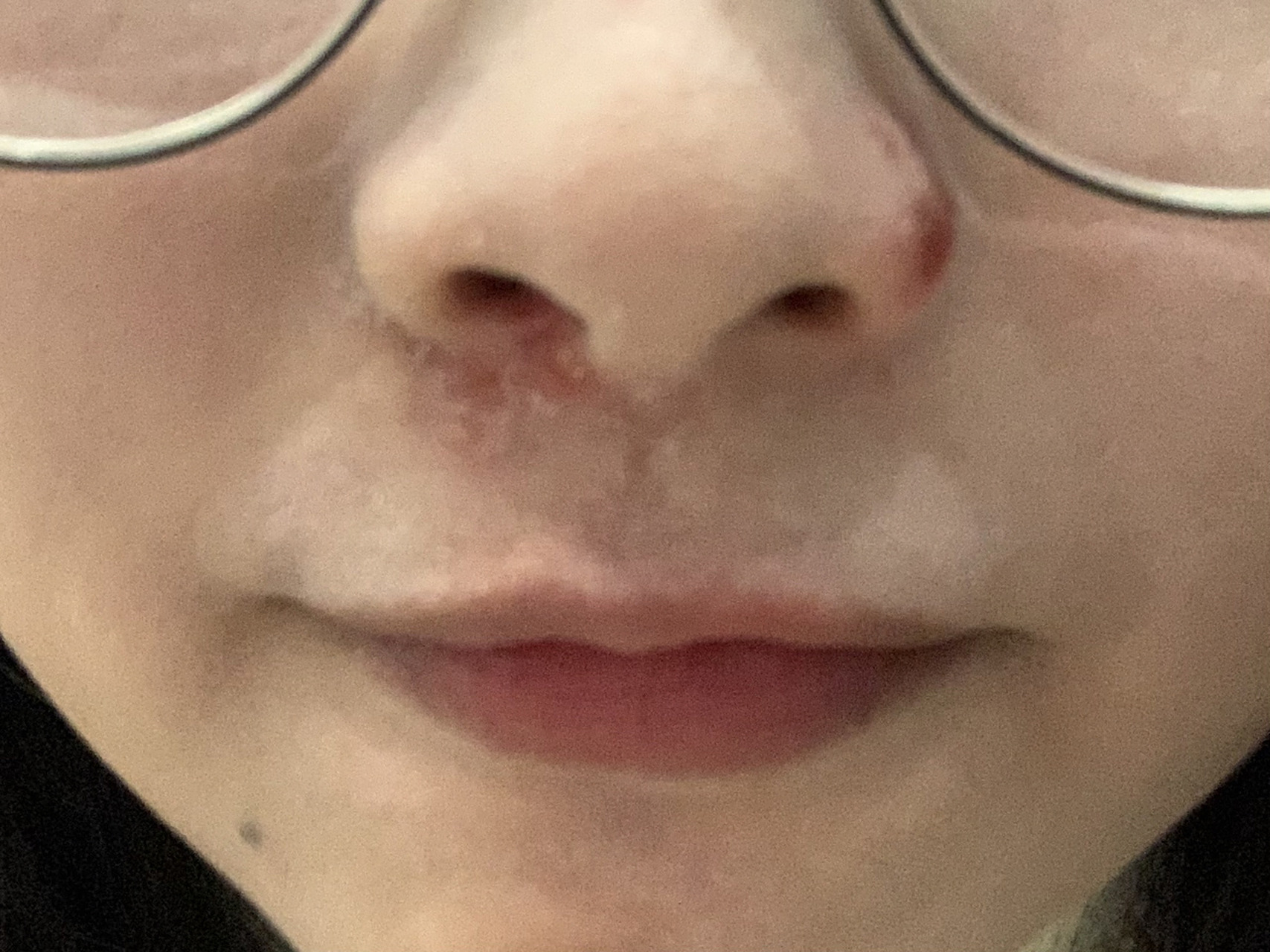 鼻周病毒性疱疹 记不清什么时候开始,每到冬春季节就发疱疹,以往都是