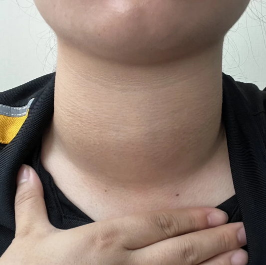 脖子粗大是怎么回事?