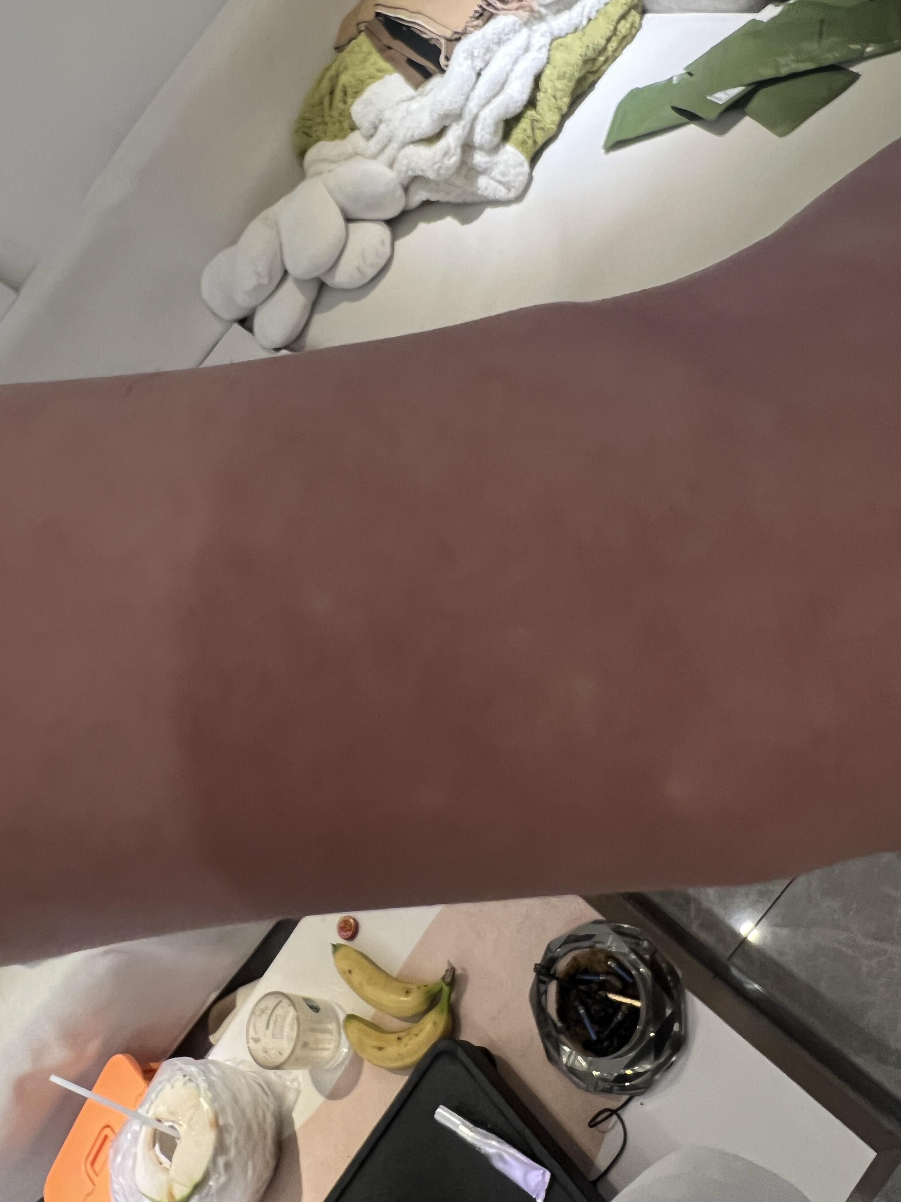 回形针 的想法: 这是贫血痣吗#痣 贫血痣