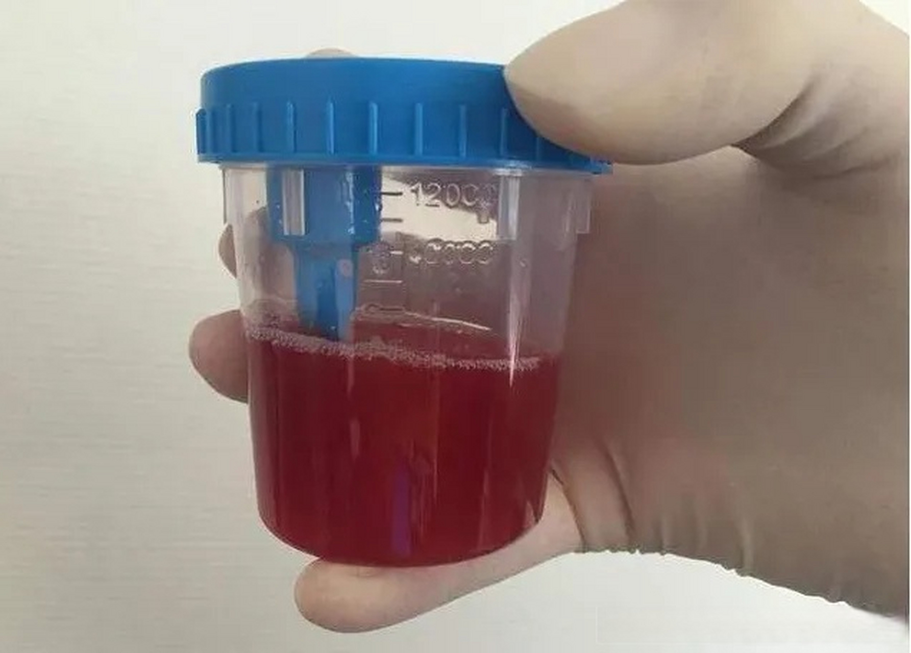 霍先生22岁,14年6月底发烧后出现肉眼血尿,14年11月做肾穿提示:轻度系