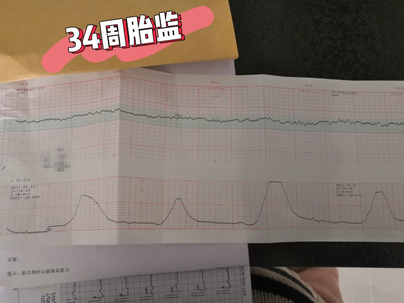 34周宫缩频繁千万不要这样 第一次做胎监,医生告诉我宫缩频繁,已经