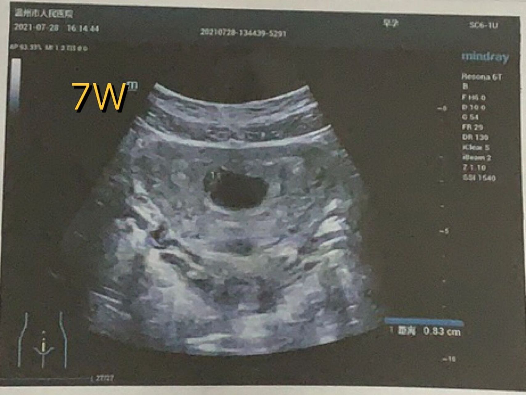 纯属好奇 看了很多帖子总结出 圆圆的孕囊的应该是个女孩 但是看尺寸