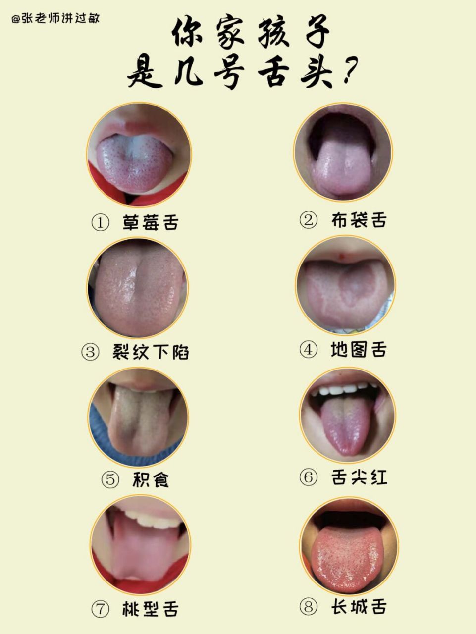 ①草莓舌:草莓舌的出现多是因为猩红热,主缺锌,表现