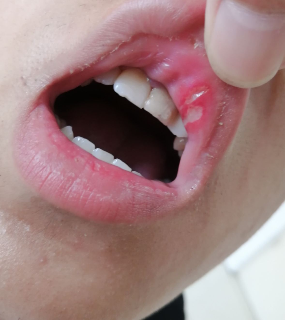 挨着牙齿的嘴内侧烂了,常见原因有口腔溃疡,灼口综合征,口腔念珠菌