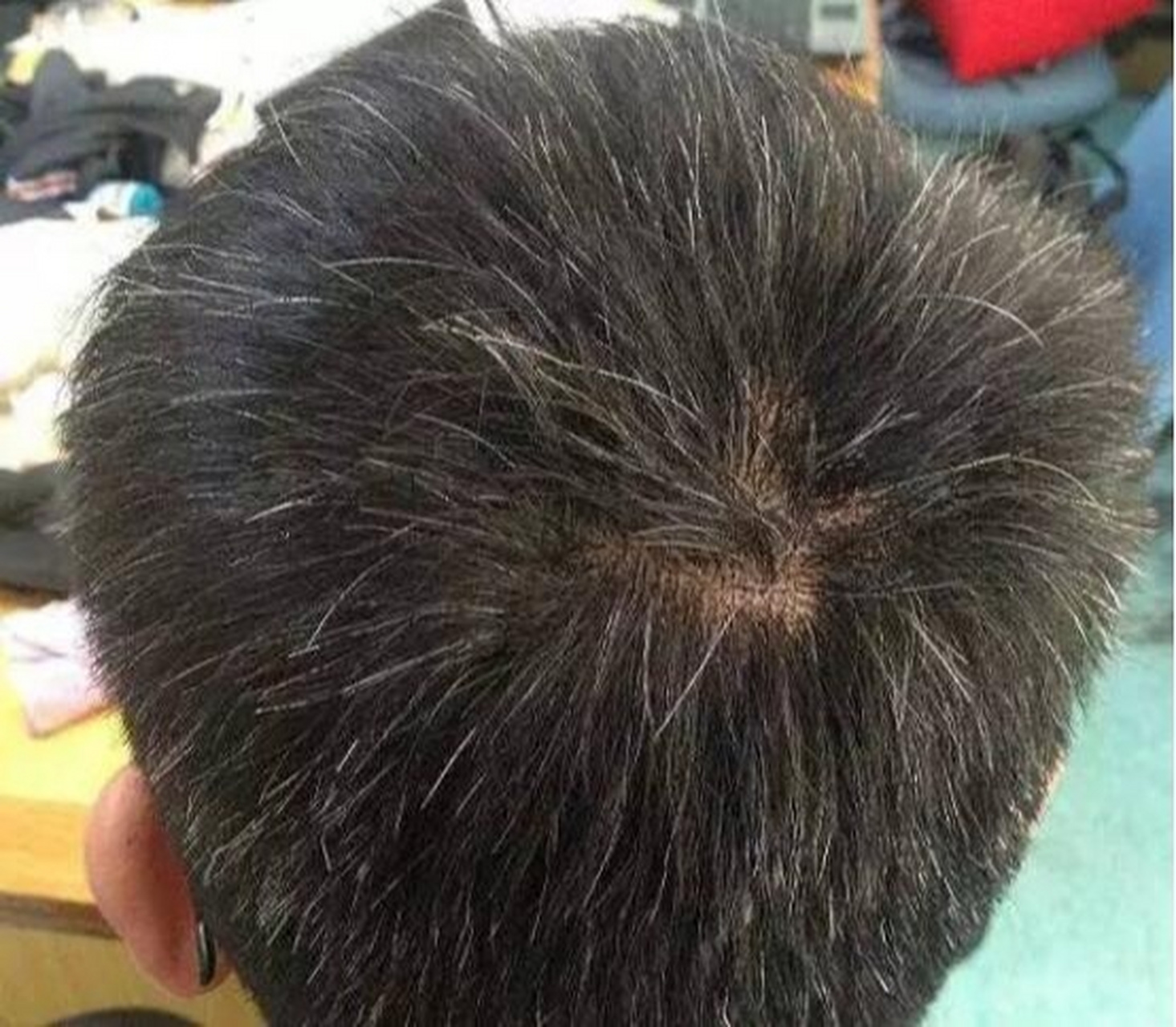 青少年白发病应该怎么办? 在饮食上应注意多摄入含铁和铜的食物.