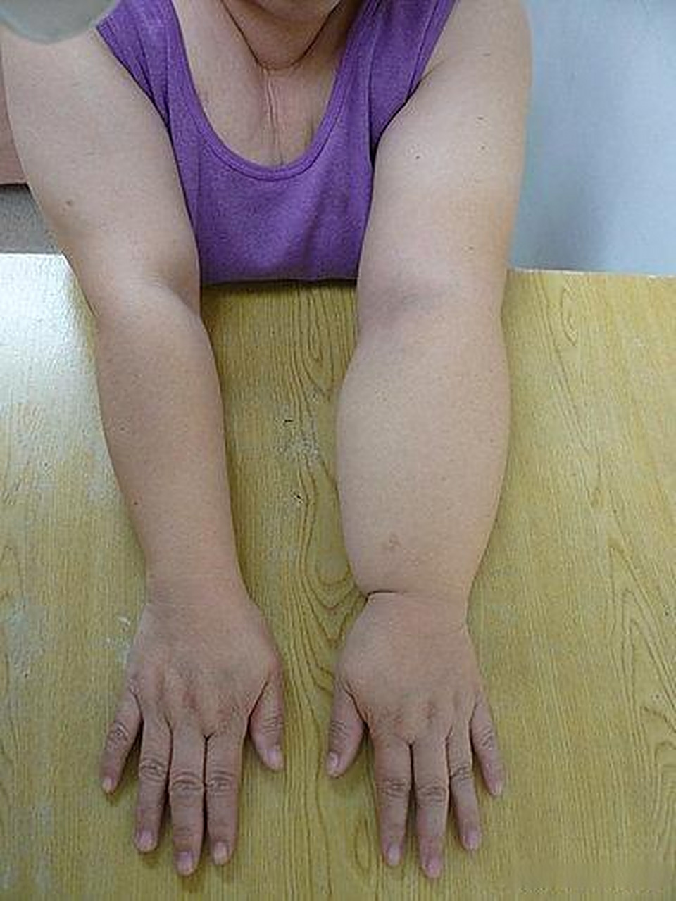 乳腺癌术后上肢淋巴水肿 乳腺癌淋巴清扫术后破坏了淋巴回流系统,导致