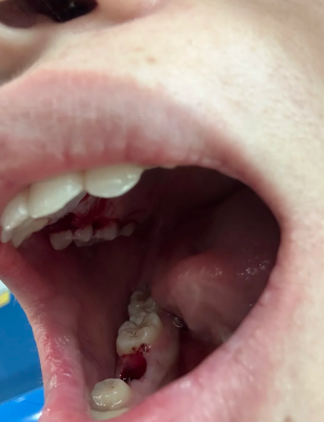 拔牙后如果出现干槽症,通常会在术后3