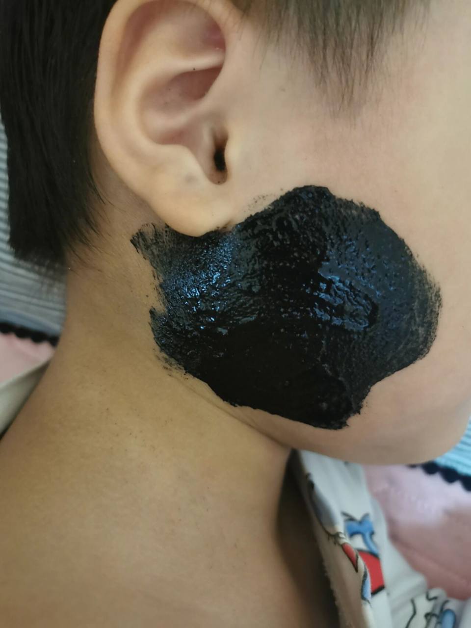 儿童急性腮腺炎怎么办 我教你 我孩子是9月28日晚上五点多突发急性