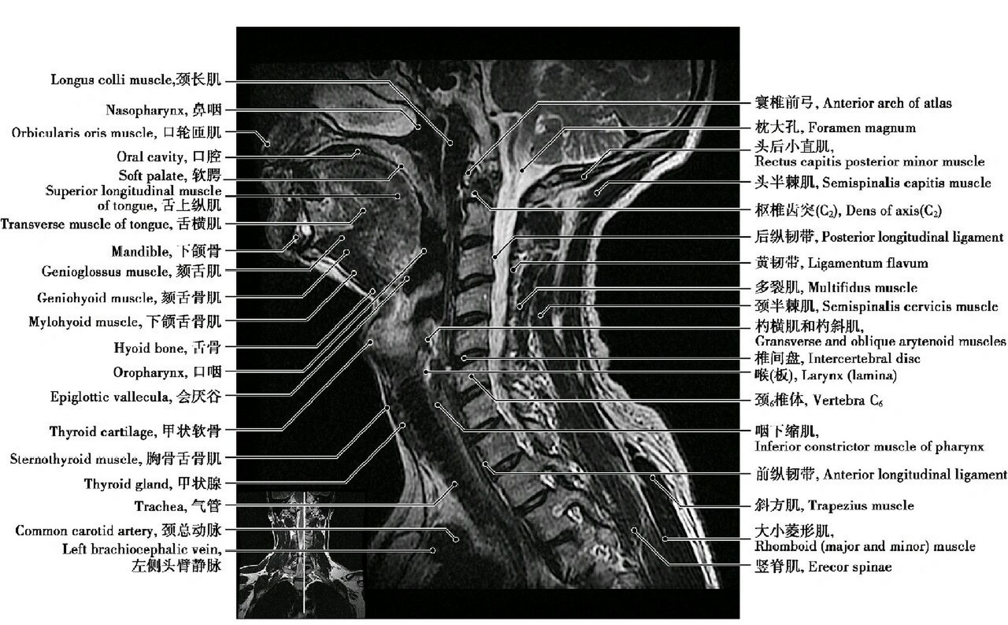 颈椎磁共振图片详解图片