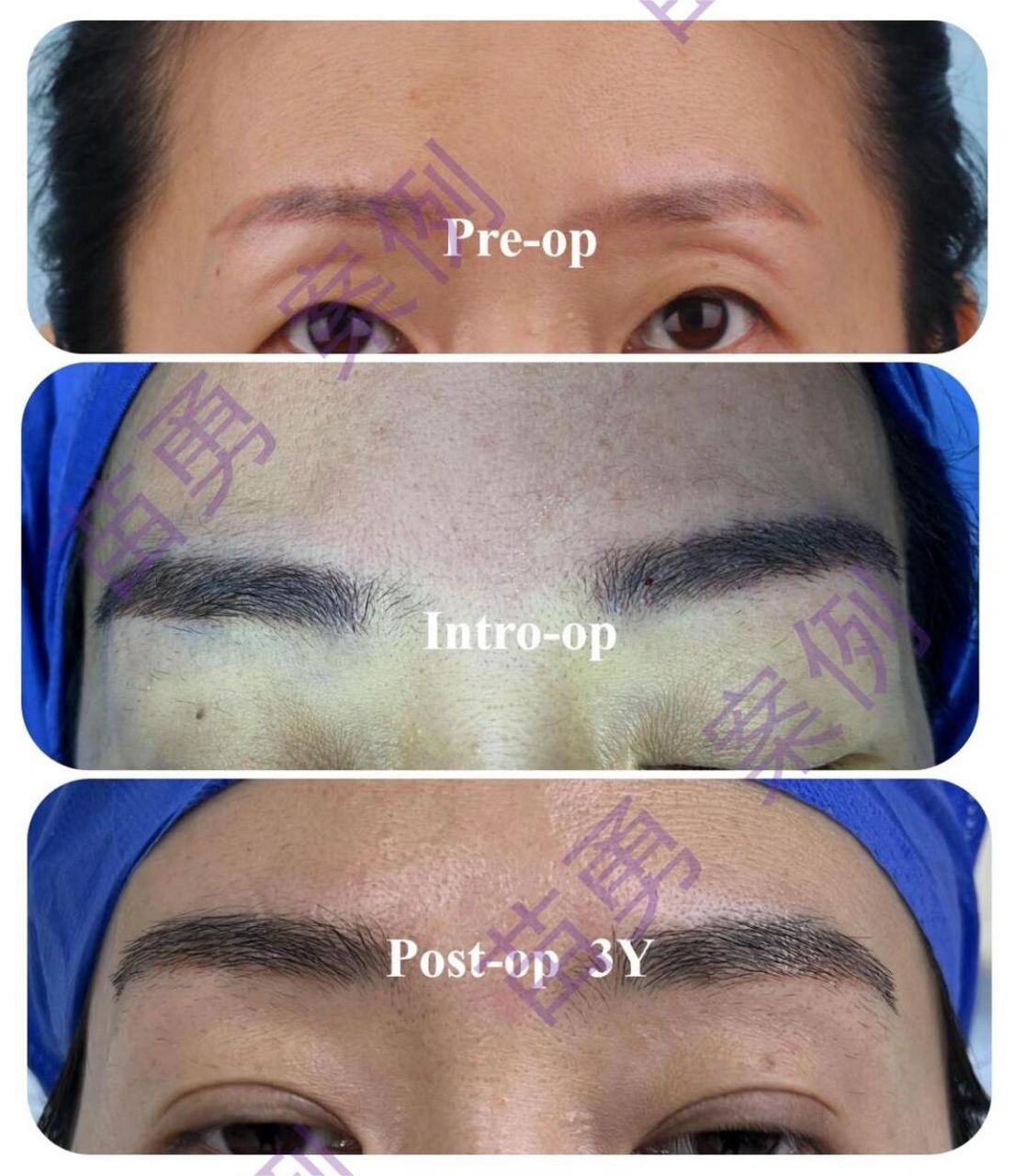 女性眉毛种植(3) 纹眉后皮肤发红,植眉改善.