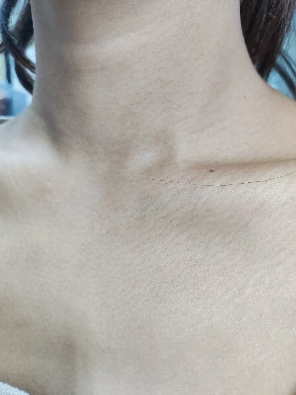 这是什么呀 不知道是不是雌激素低受黑棘皮的影响,因为我脖子后面就有