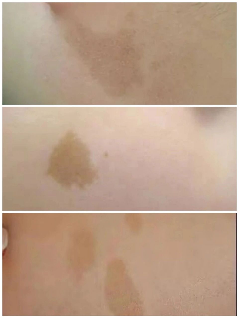 咖啡斑与神经纤维瘤的区别与诊断 94有一个数据是这样说的,90%神经