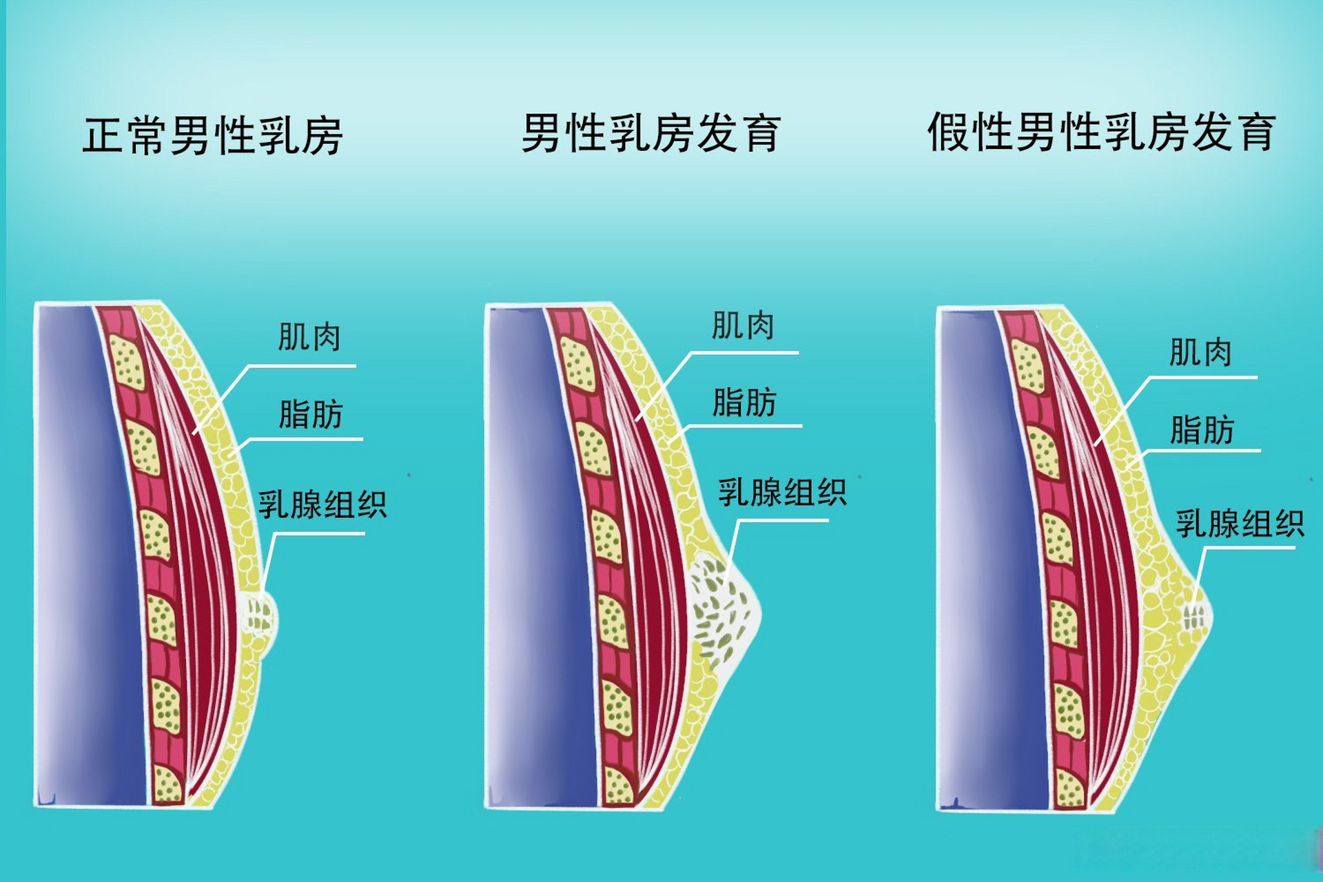 男性乳腺腺体发育图片