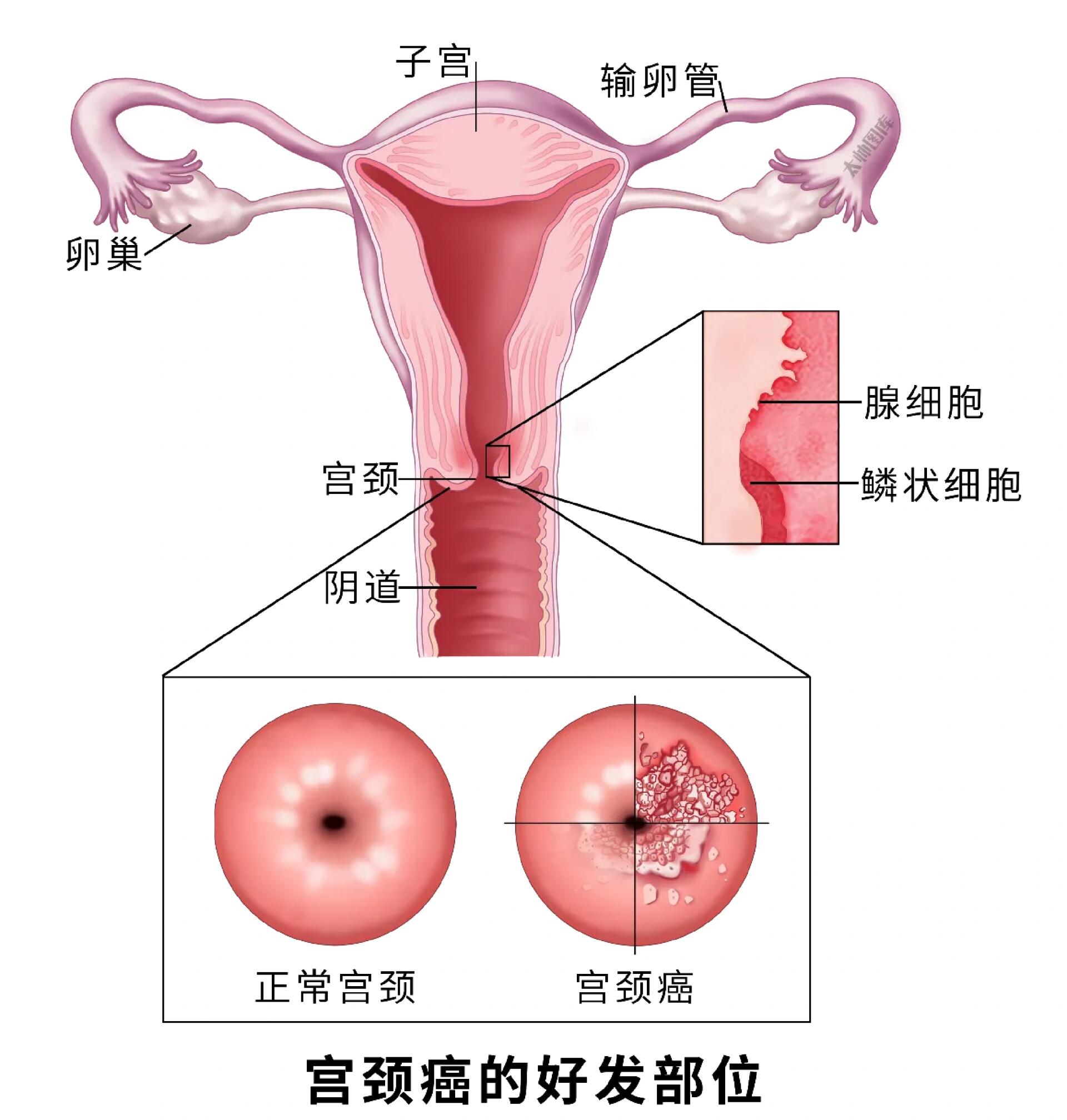 子宫颈长什么样看图片图片