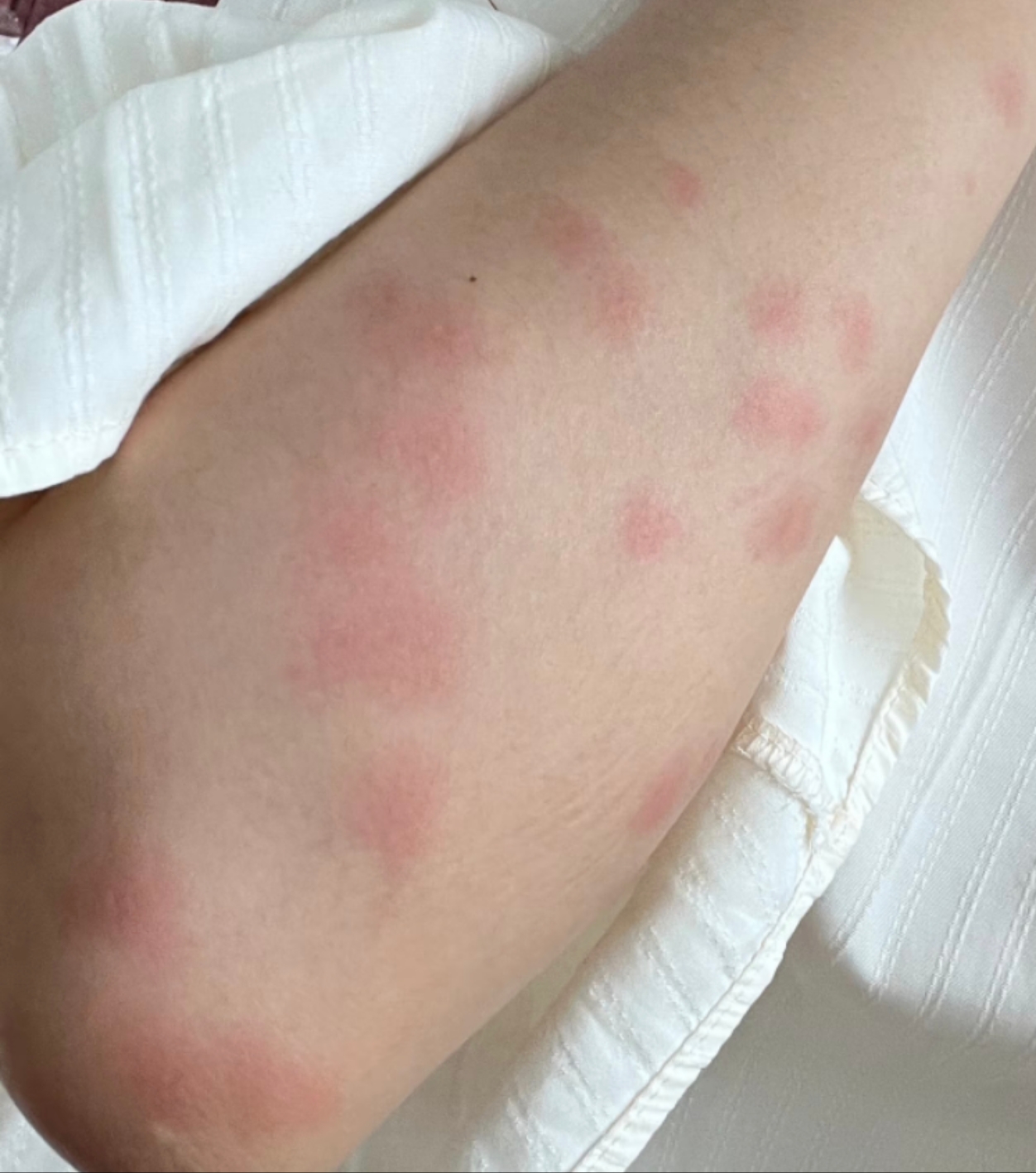 如果被蚊虫叮咬,蚊子唾液中的酸性物质会刺激皮肤,引起免疫反应