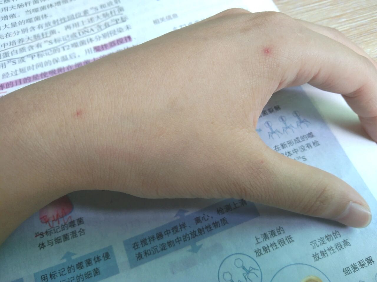 蜘蛛痣 它是红色的一个小圆点 不痛也不痒没有什么感觉而且消不掉!