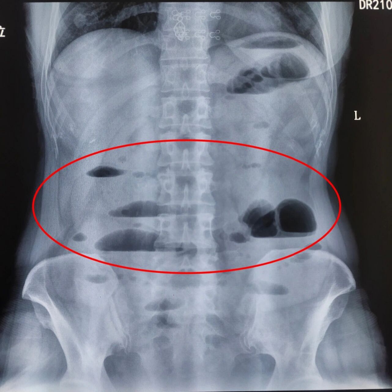 诊断意见: 考虑黏连性肠梗阻,建议进一步检查.