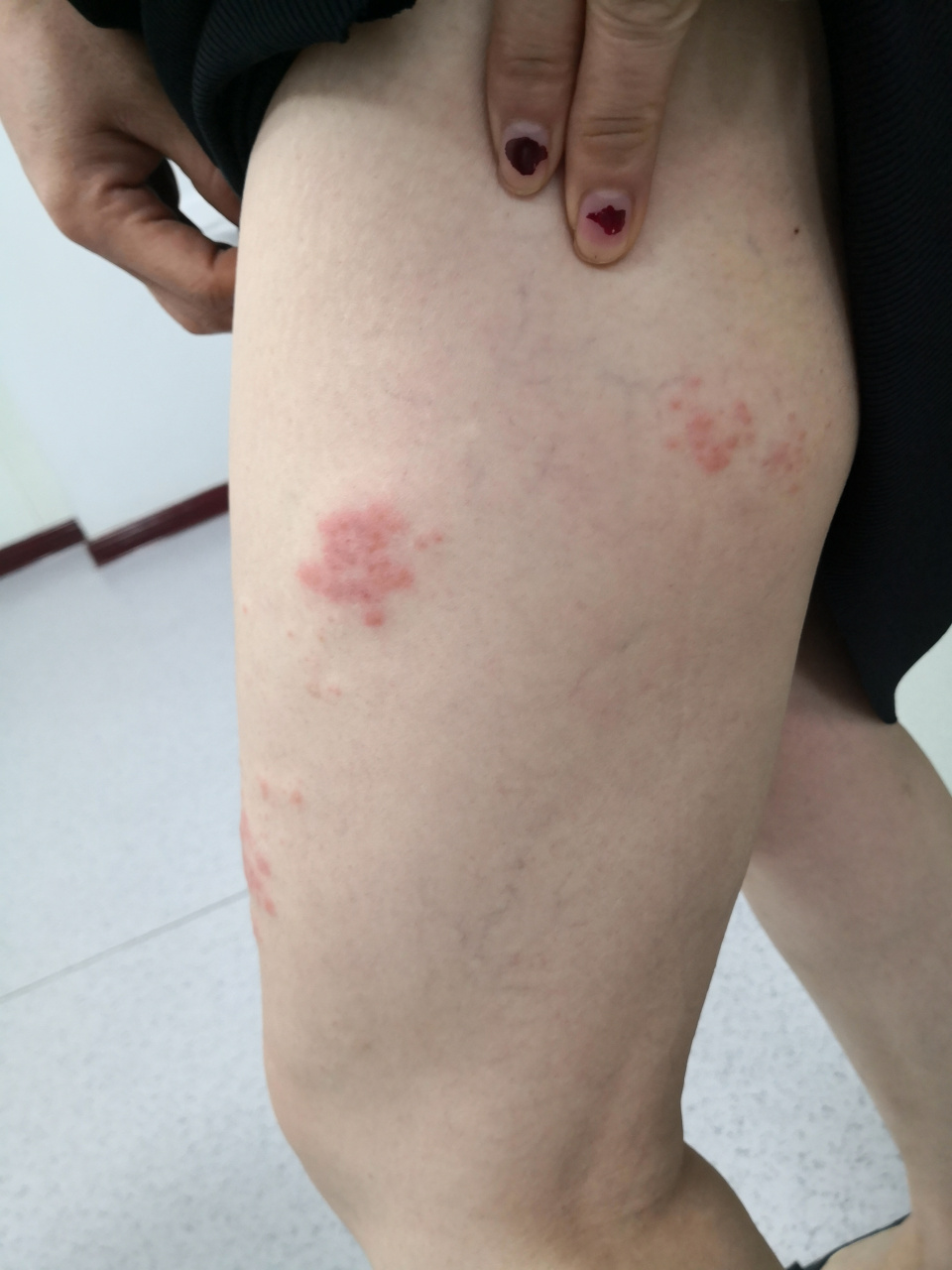 左下肢带状疱疹症状.红斑小疱.带状分布.