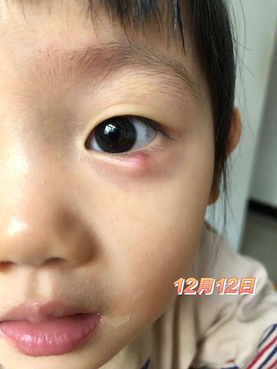 儿童霰粒肿不开刀保守治疗 10月底的时候妞妞突然眼袋有点红,开始以为