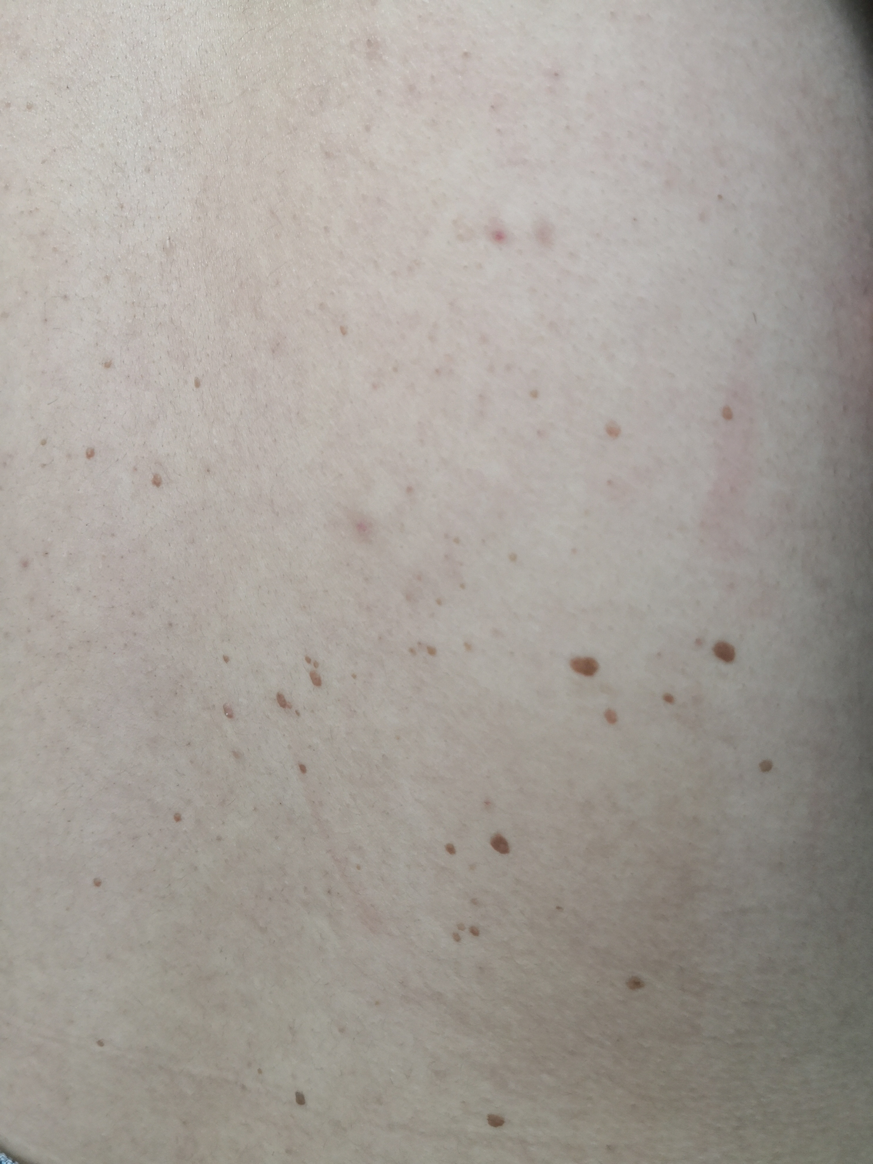 背部黑褐色斑块,考虑.@纪秀军皮肤科主任医师的动态