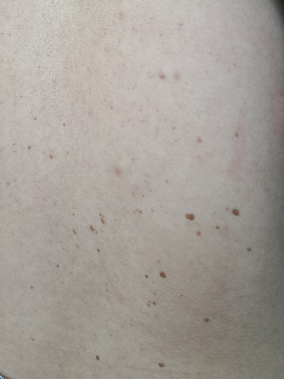 背部黑褐色斑块,考虑脂溢性角化/老年斑症状.