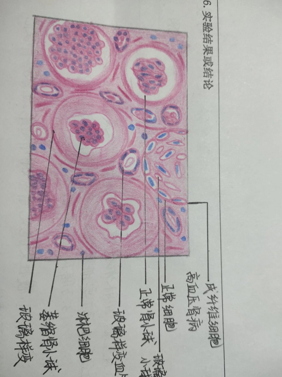 动脉粥样硬化红蓝铅笔图片