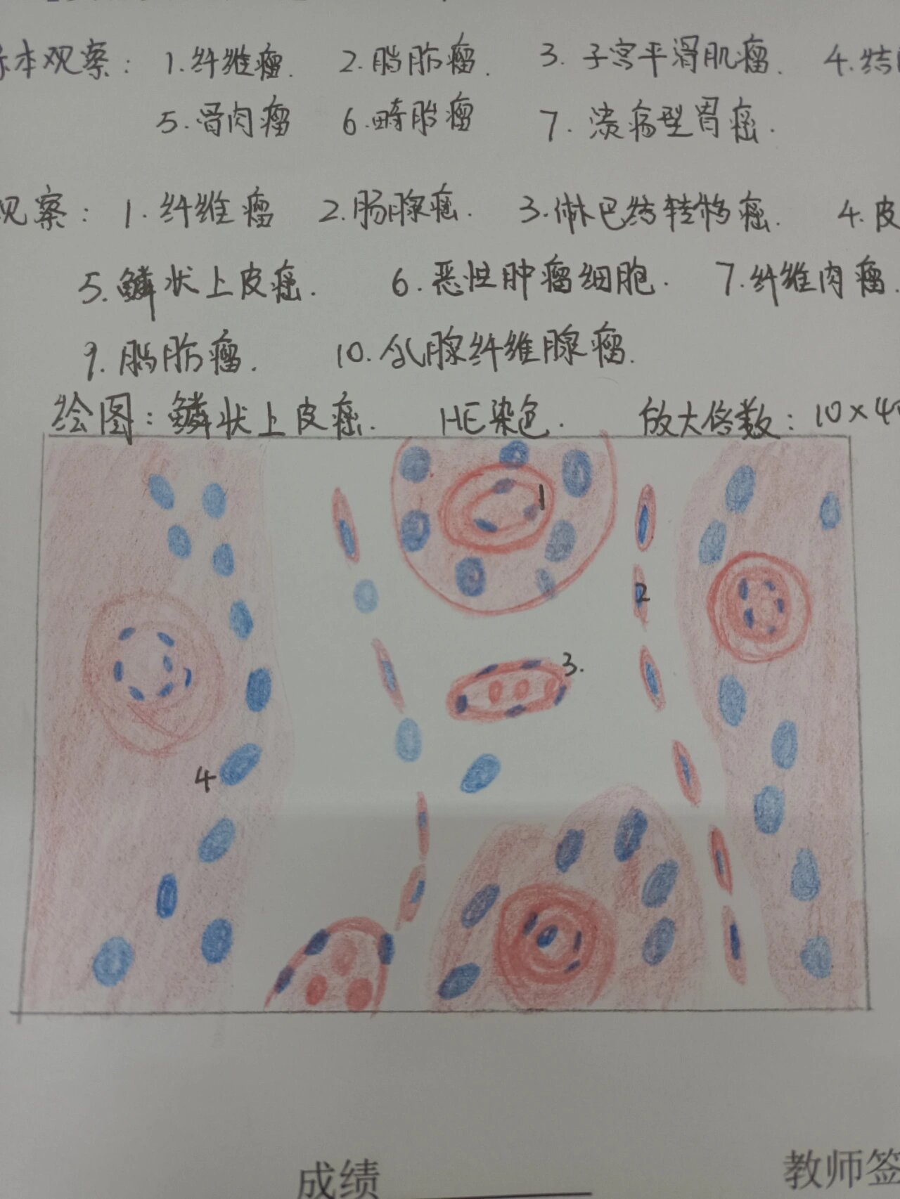 鳞状上皮癌红蓝铅笔绘图 病理学与病理生理学红蓝铅笔绘图