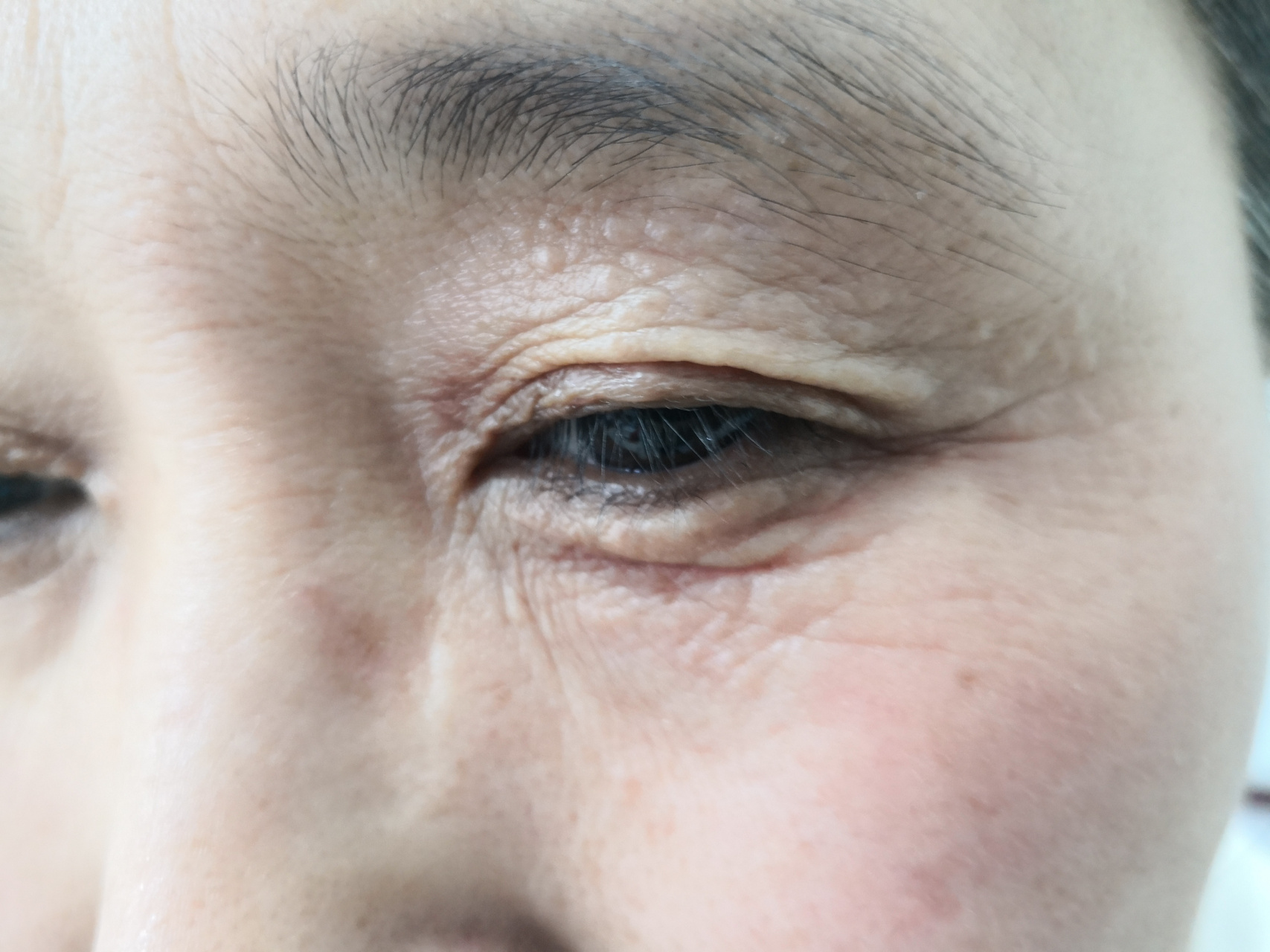 眼睑汗管瘤症状#解决皮肤问题专注皮肤美容# 可以使用激光治疗去除.