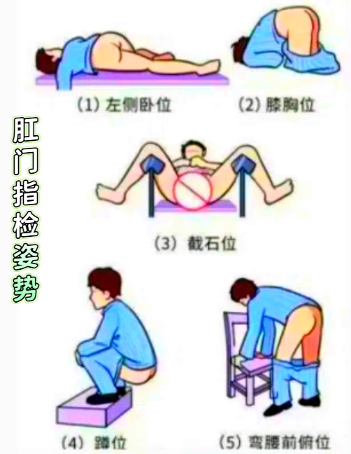 女性肛检主要包括肛门指检和肛门镜检查两种方法