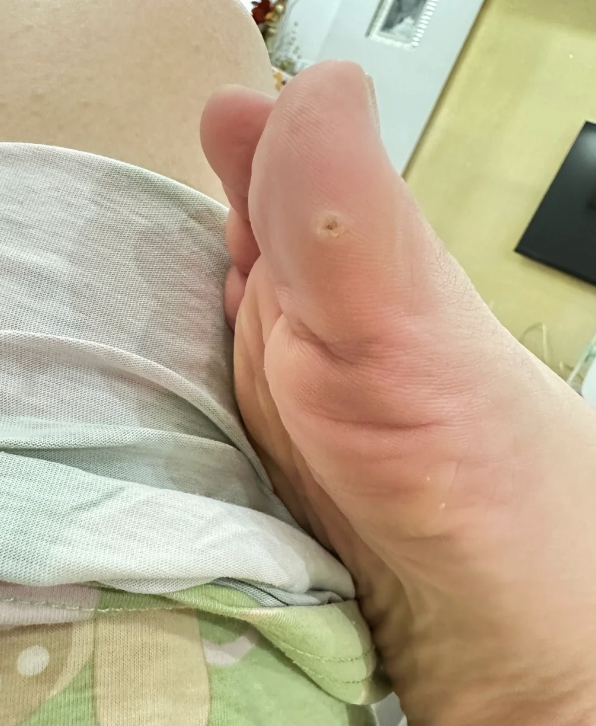 大拇趾上长鸡眼,通常是由于鞋子不合脚,长期站立或行走,脚部畸形