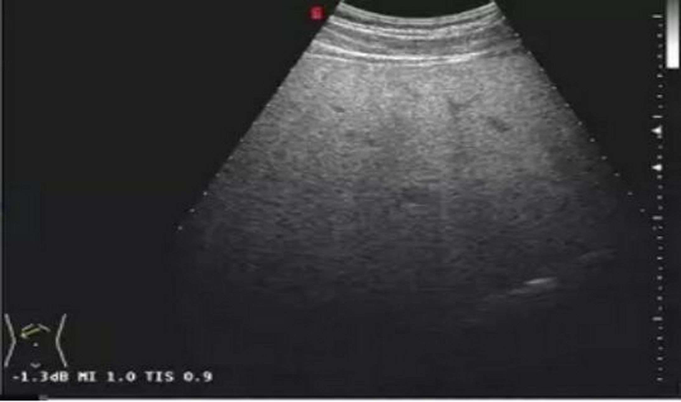 如何区分脂肪肝的程度,你知道吗?