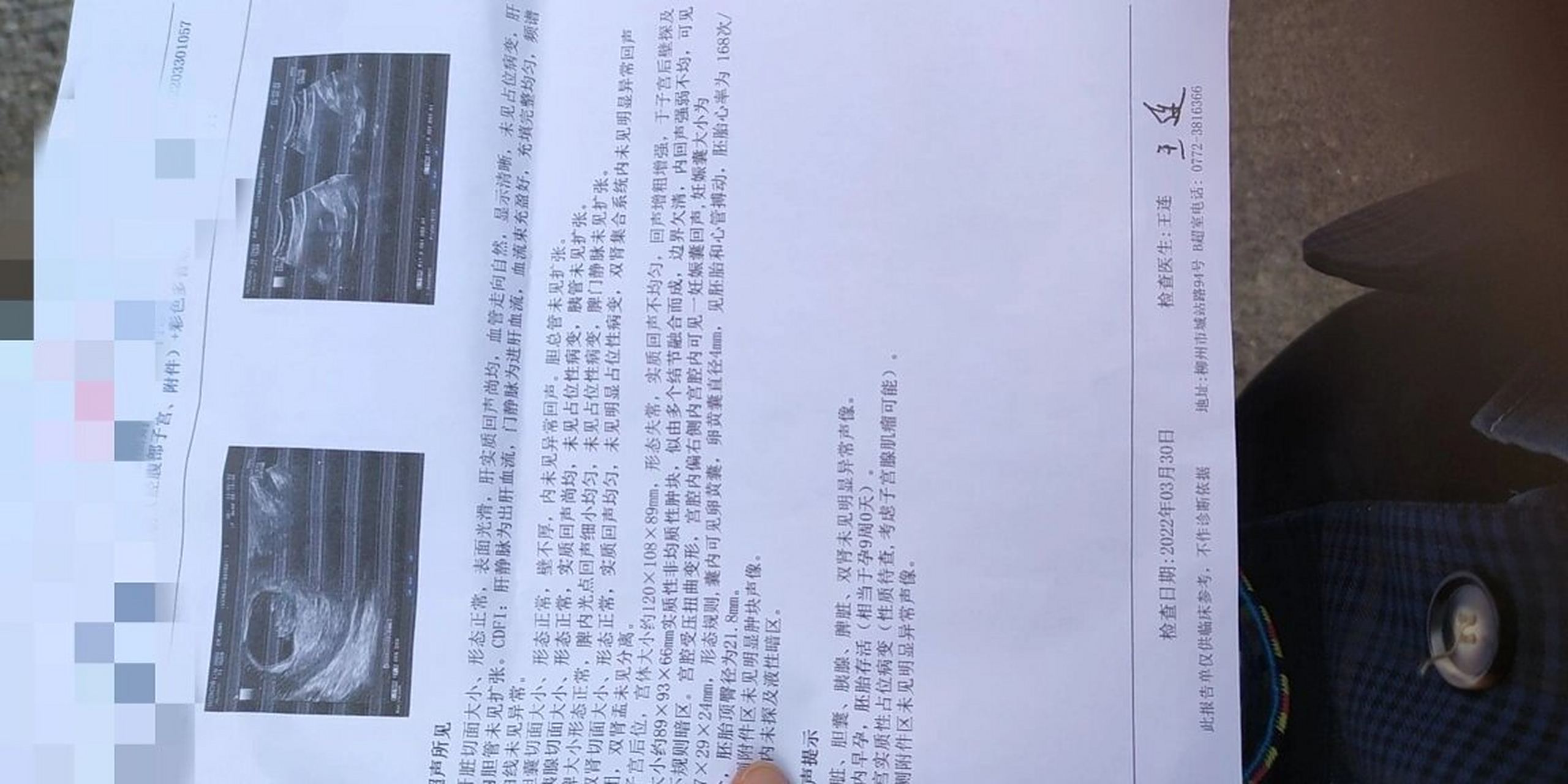 腺肌症怀孕,真的好累 末次月经1.