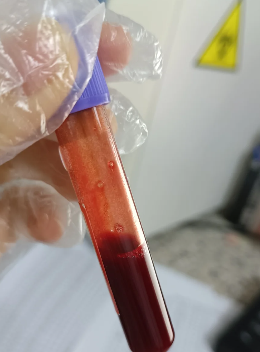 常规检查包括血常规,凝血功能,心电图和全景片