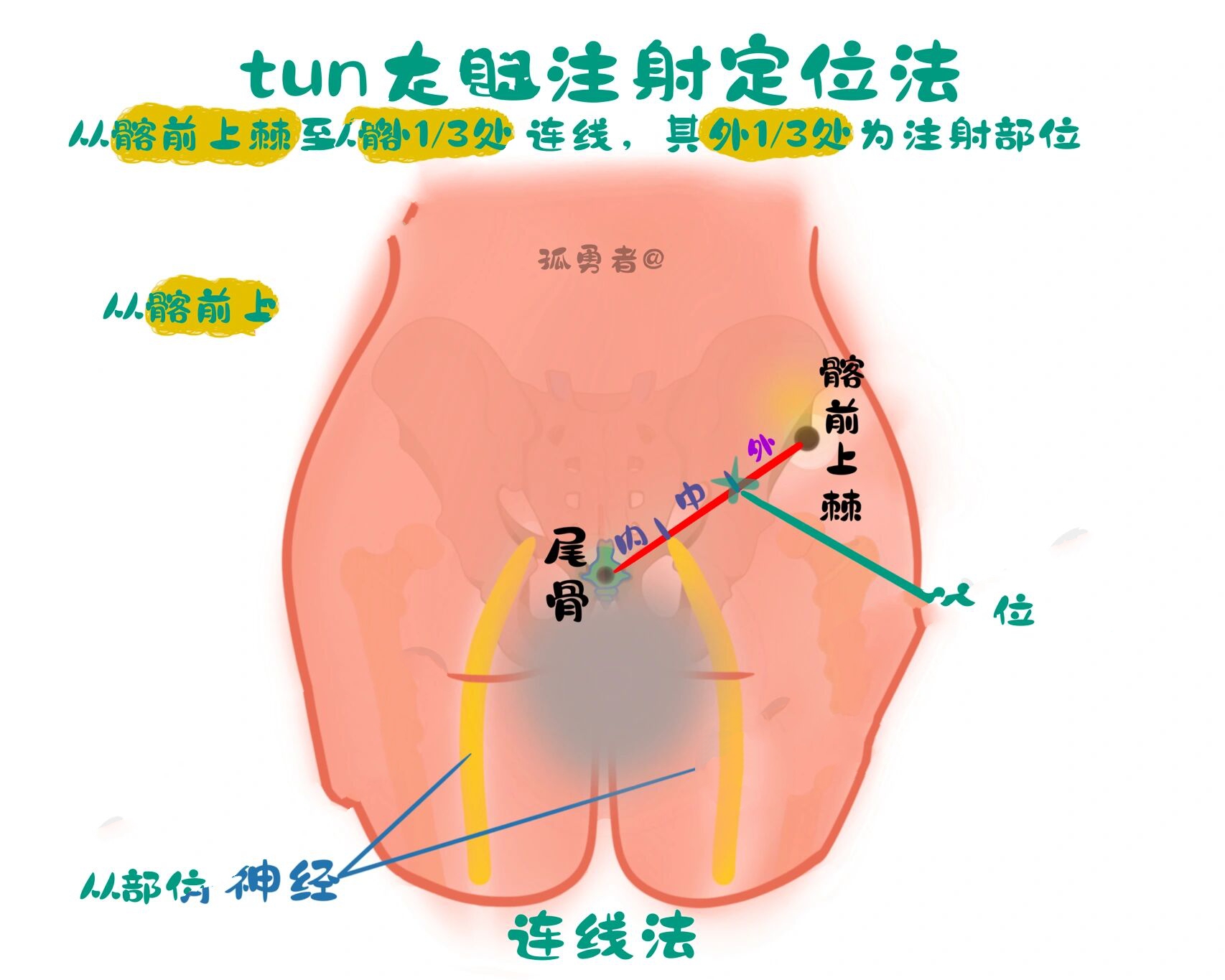 臀大肌定位