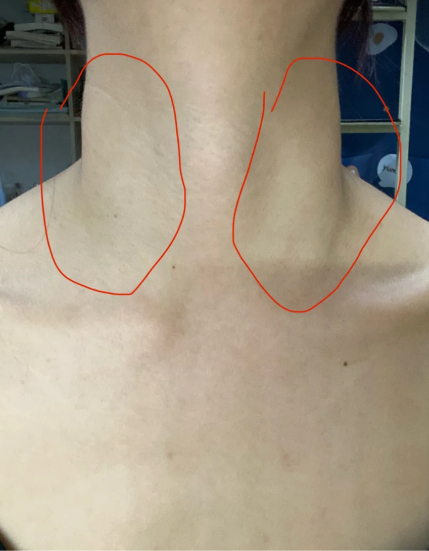 甲状腺1度肿大也叫甲状腺Ι度肿大,意思是甲状腺有轻微肿大的情况