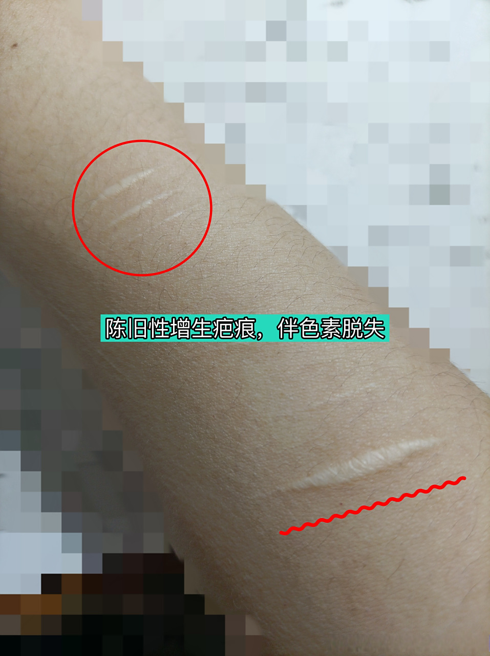 增生性疤痕伴有色素脱失,时间越久激光修复效果越差.