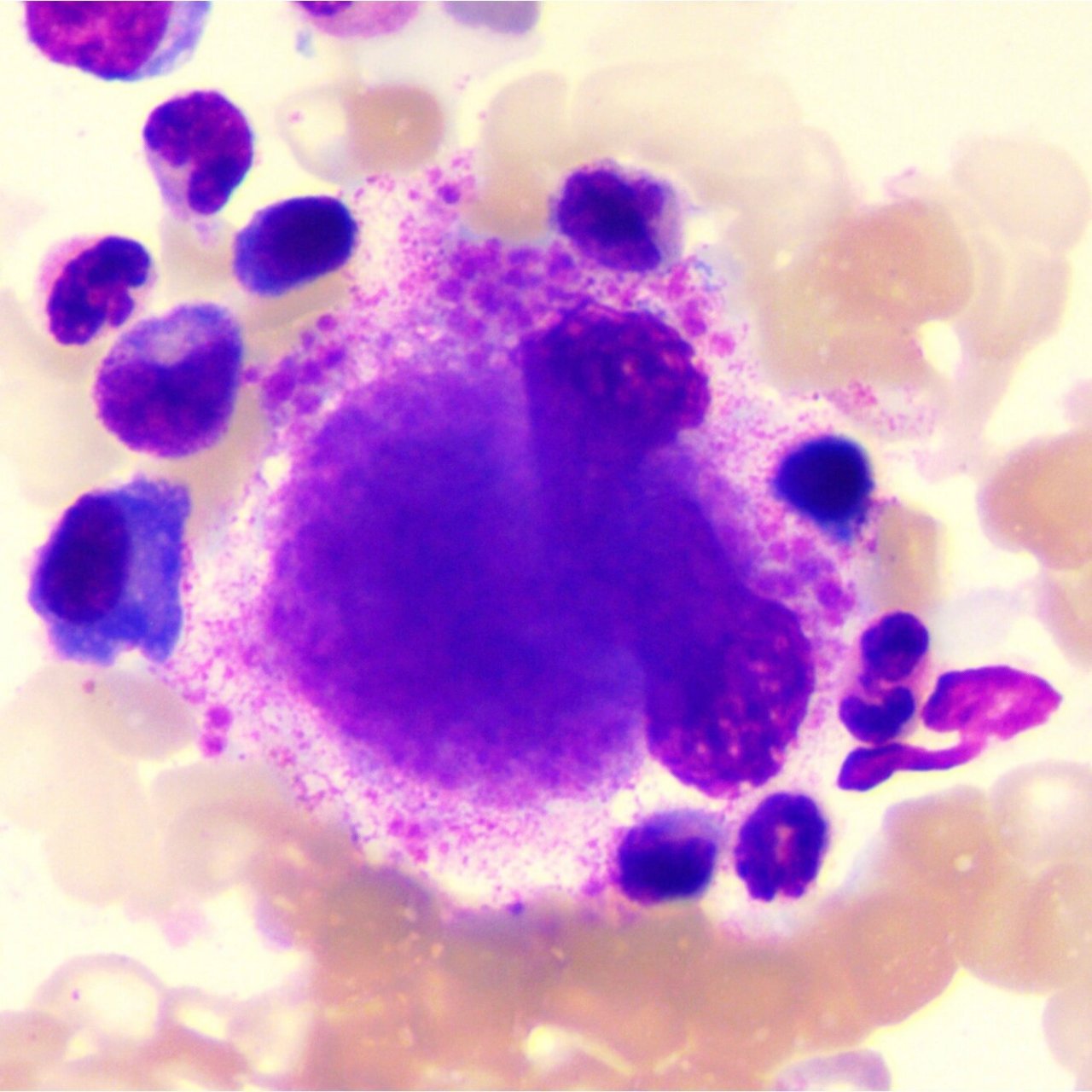 产板型巨核细胞 产板型巨核细胞:胞体巨大,胞体直径40～70 μm,有时