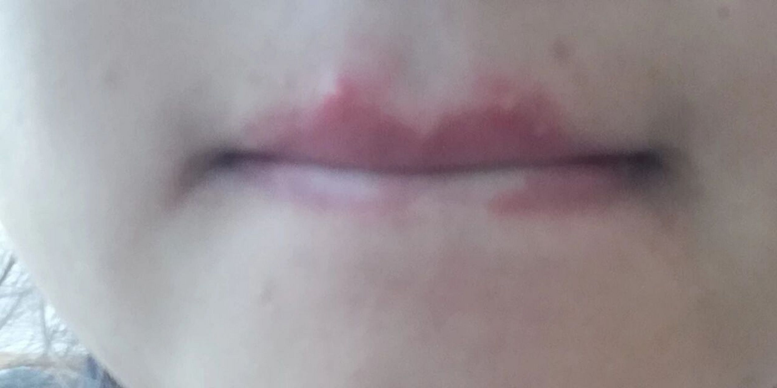 嘴唇上长了3个小痘痘,又红又痛,请问有什么办法吗?在线等,谢谢