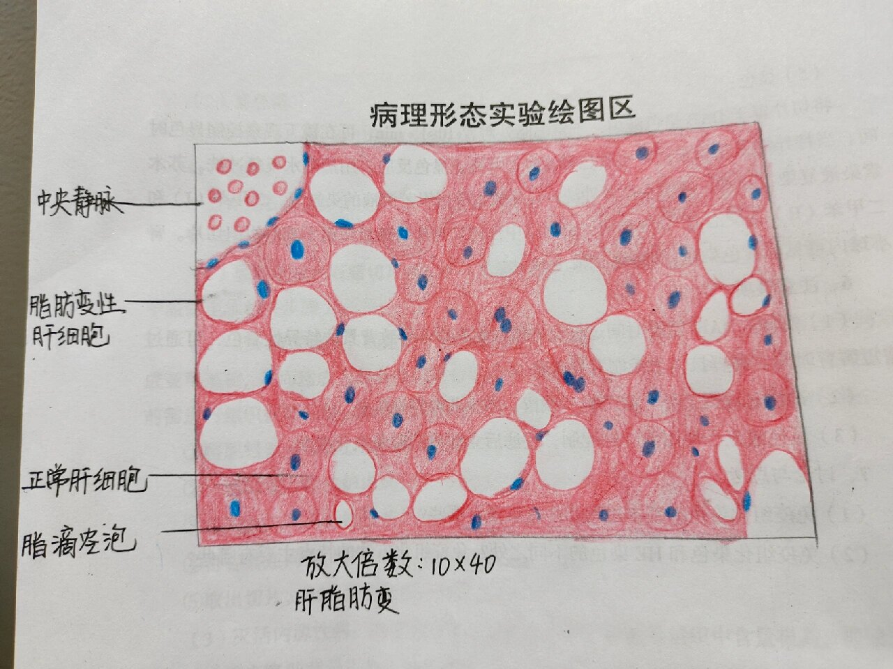 肝脂肪变红蓝手绘图片